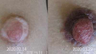 백반증 커버업 전 후